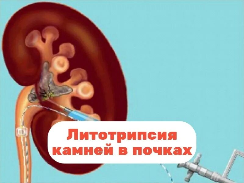 Литотрипсия желчных камней. Литотрипсия желчных камней