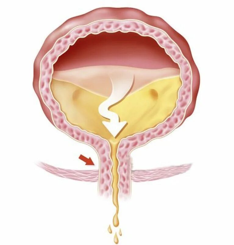 Мочевой пузырь недержание. Парадоксальная ишурия. Задержка мочеиспускания - ишурия. Стаз мочи в мочевом пузыре. Мочевой пузырь после 60 лет