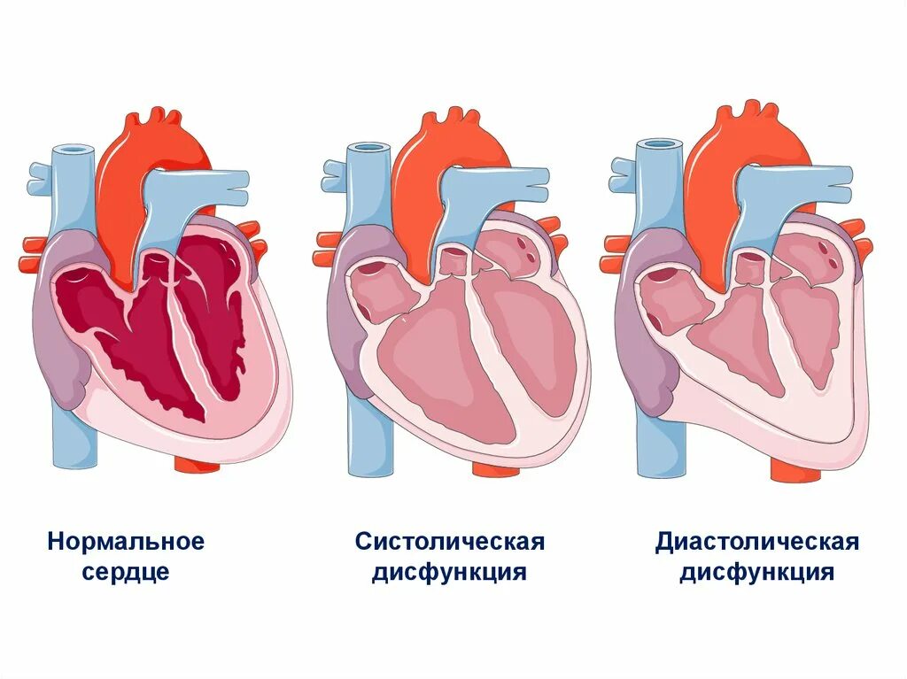 Дисфункции желудочков сердца. Систолическая и диастолическая дисфункция левого желудочка. Систолическая дисфункция сердца. Систолическая и диастолическая сердечная недостаточность. Нарушение систолической и диастолической функции сердца.