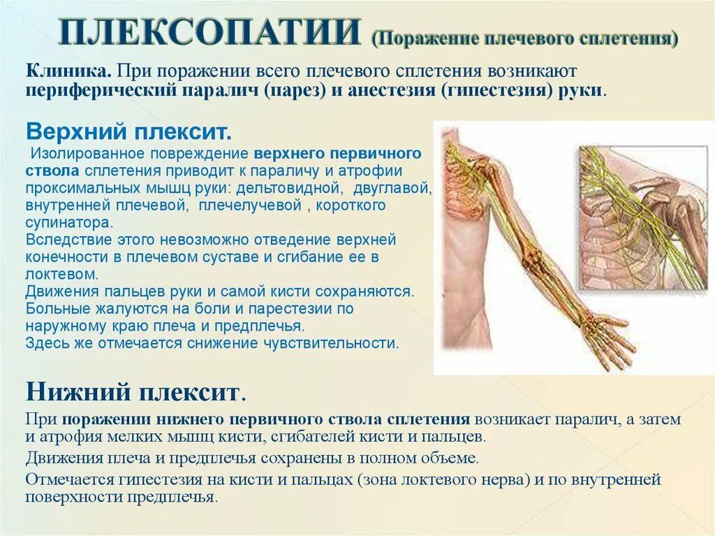 Плексит неврит плечевого нерва. Плексит плечевого сплетения клиника. Плексит плечевого сплетения симптомы. Плексопатия плечевого нерва. Нейропатия локтевого мкб