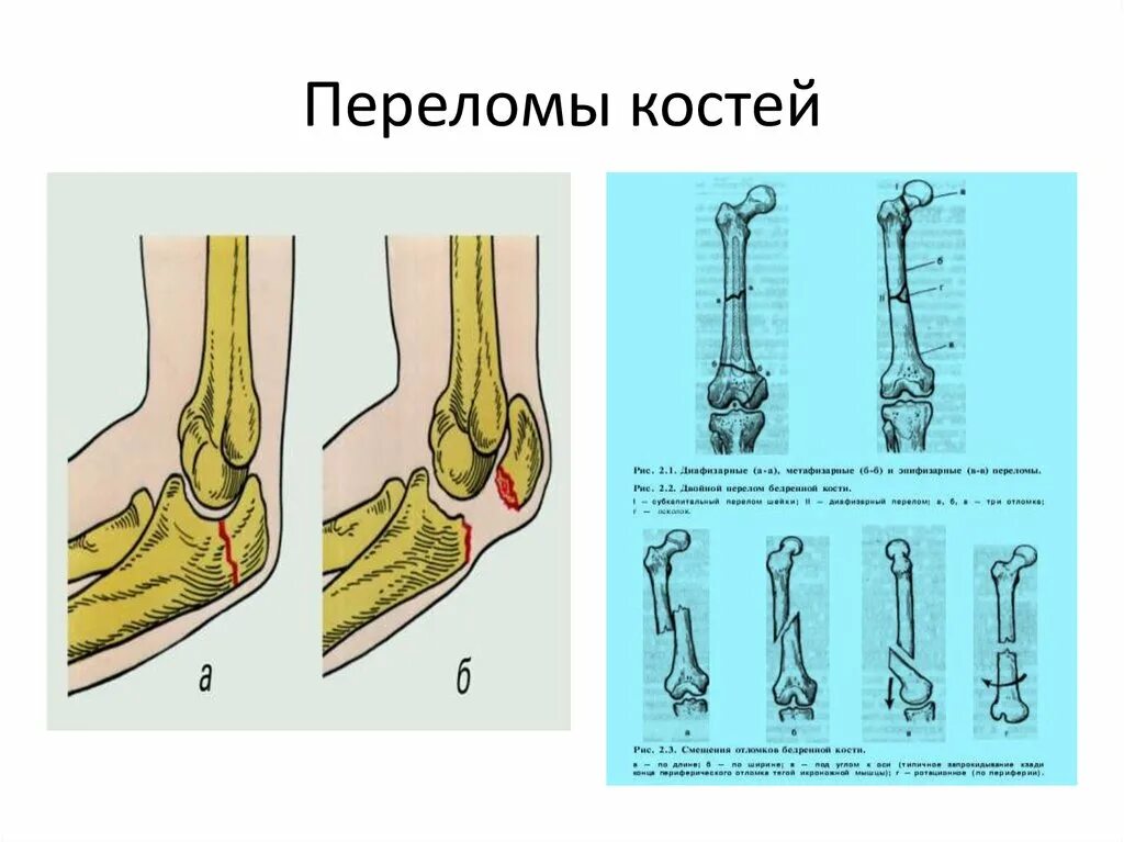 Рис перелом кости открытый.