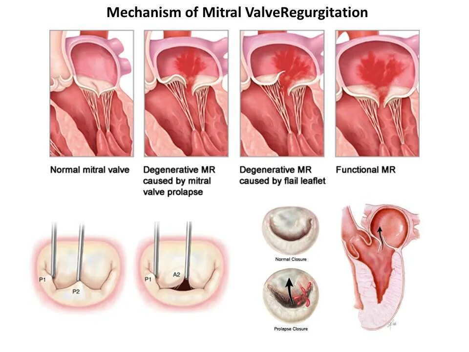 Что такое пролапс митрального клапана. Пролапс митрального клапана физикальное обследование. Пролапс митрального клапана операция. Клинические проявления пролапса митрального клапана.