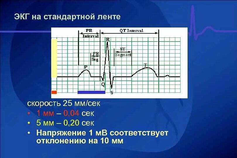 Мв на экг