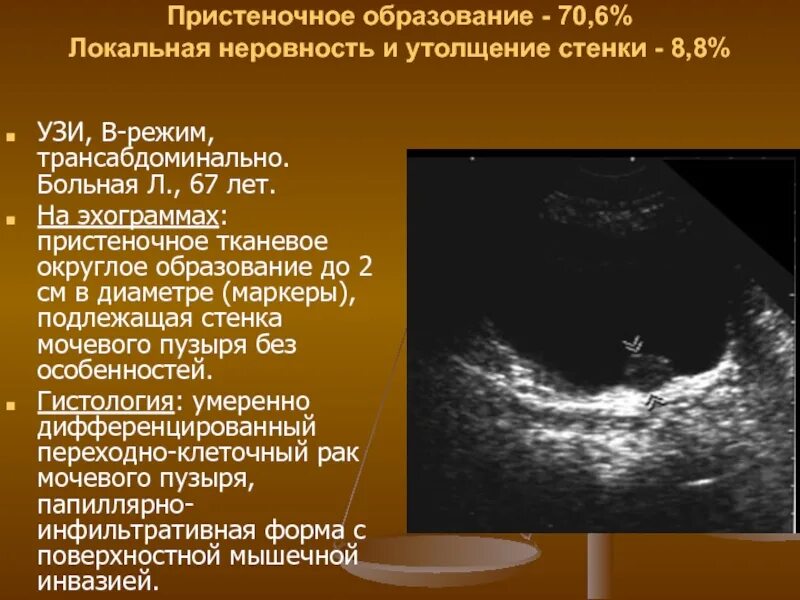 Трансабдоминальное узи. Трансабдоминального узи. ультразвуковое исследование мочевого пузыря трансабдоминальное. утолщенная стенка мочевого пузыря на узи.