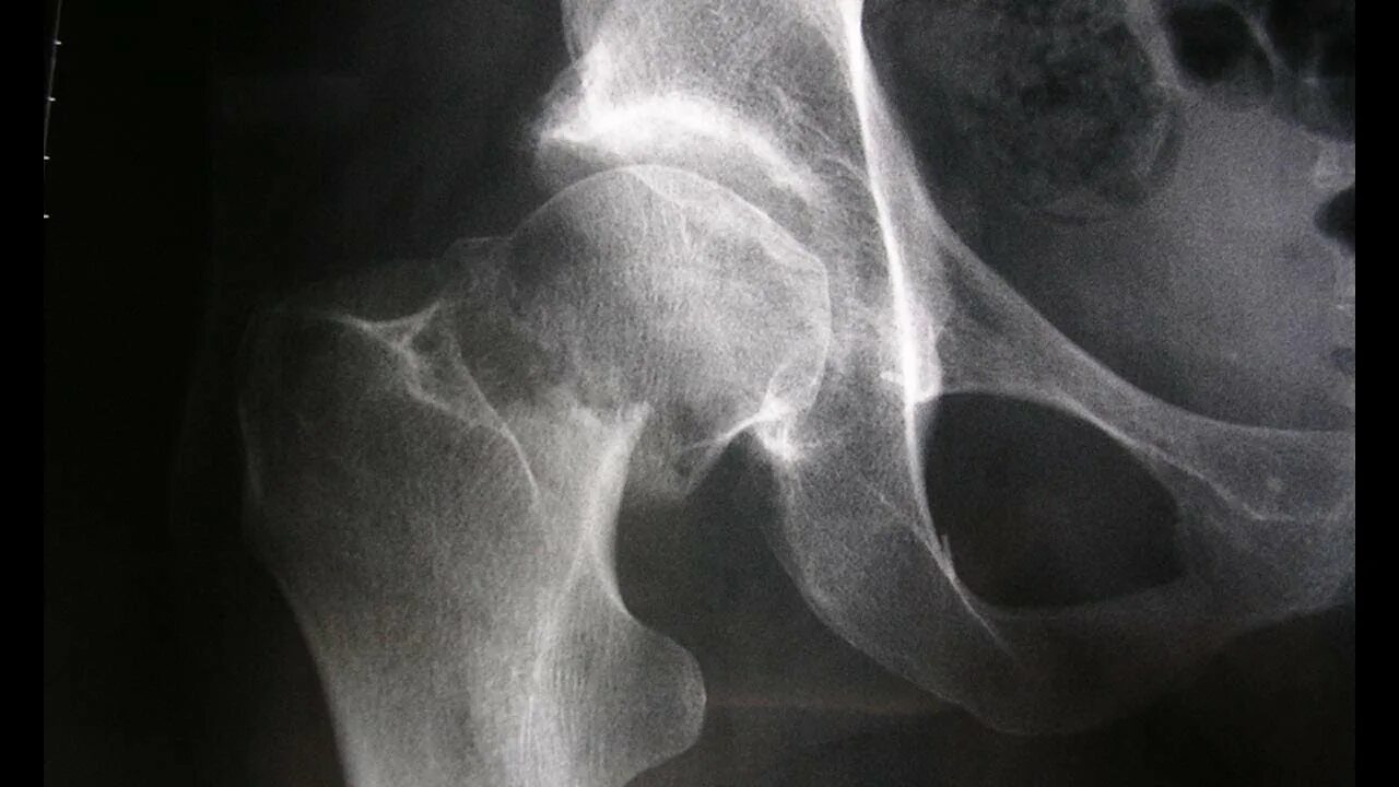 Source x rays