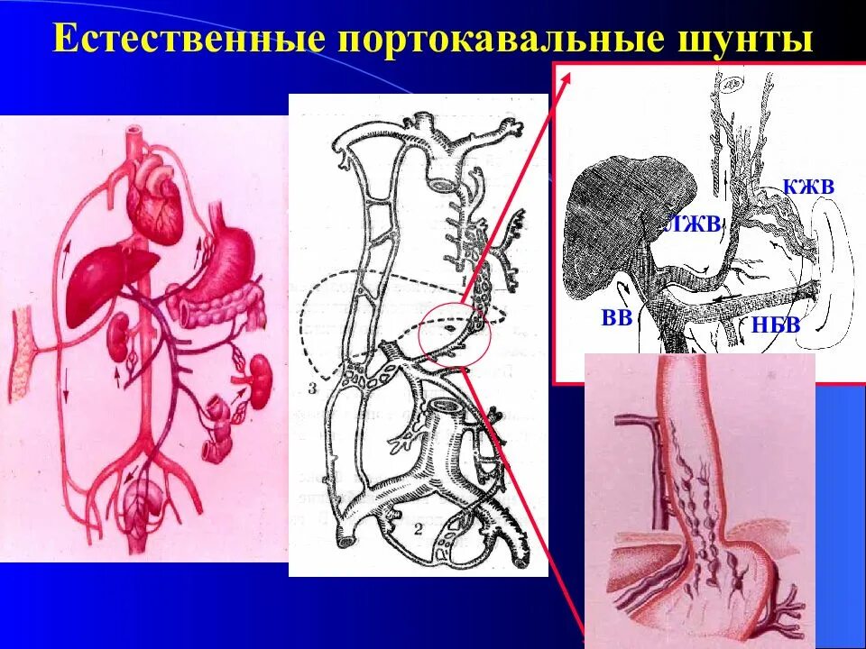 Портокавальные шунты при портальной гипертензии. Порто. Кавальные шунтв. Портокавальный шунт врожденный. Портокавальные анастомозы печени.