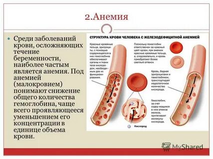Анемия что лучше принимать