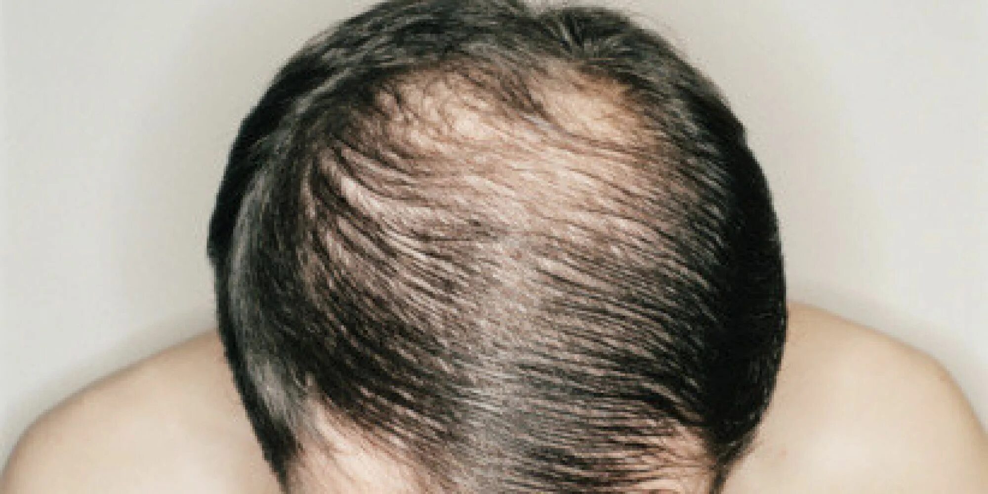 Гнёздная (очаговая алопеция). Кучерявая девушка. Frizzy hair. It can hair. Проблемные волосы.