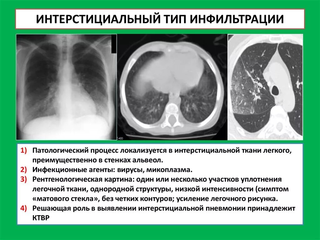 Альвеолярный Тип инфильтрации рентген. Синдром воспалительной инфильтрации легочной ткани. Инфильтрация легочной ткани при пневмонии. Интерстициальная инфильтрация на рентгене.