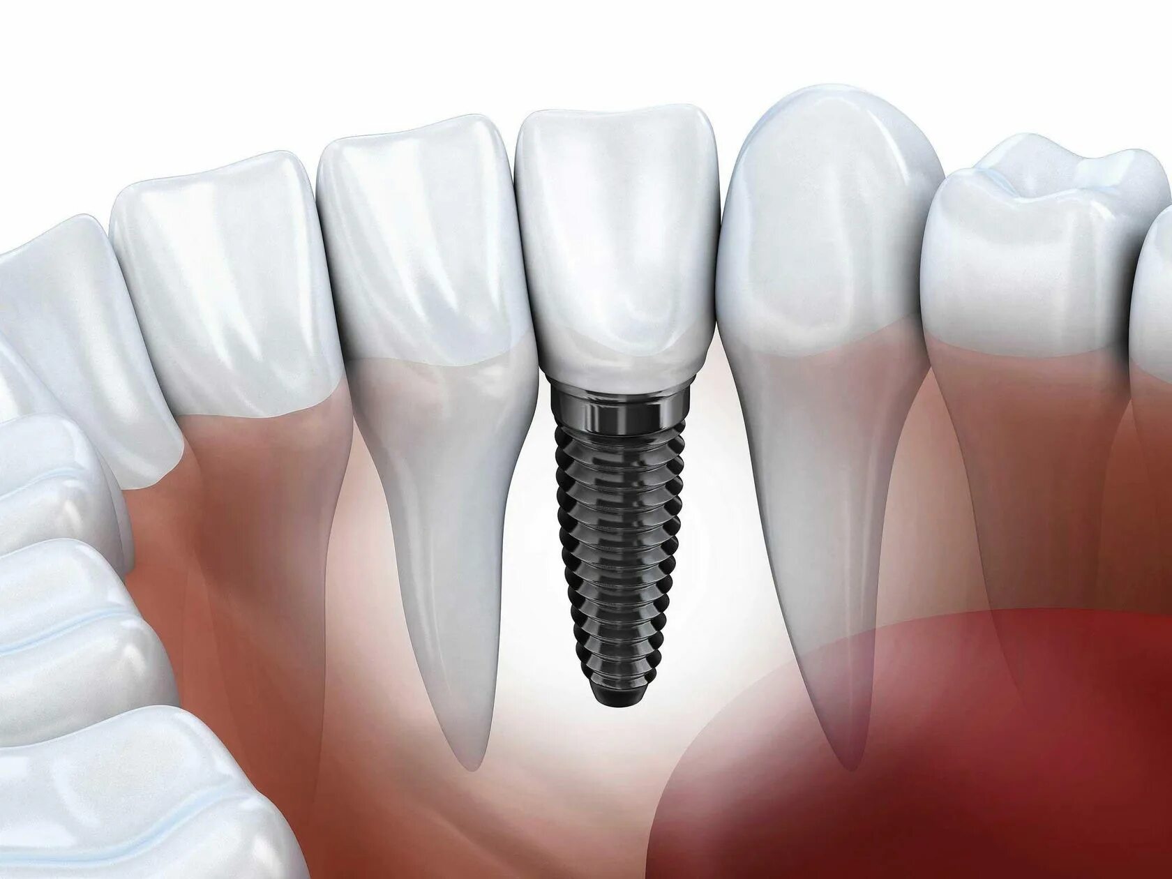 Импланты зубов Альфа био. Байкон импланты. Одноэтапная и двухэтапная имплантация зубов.