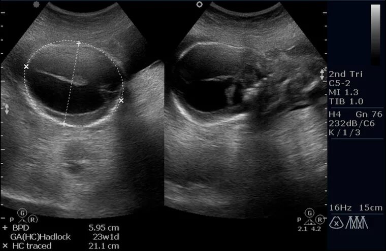 Узи аномалий. Гидроцефалия у плода на УЗИ. Водянка плода асцит УЗИ.