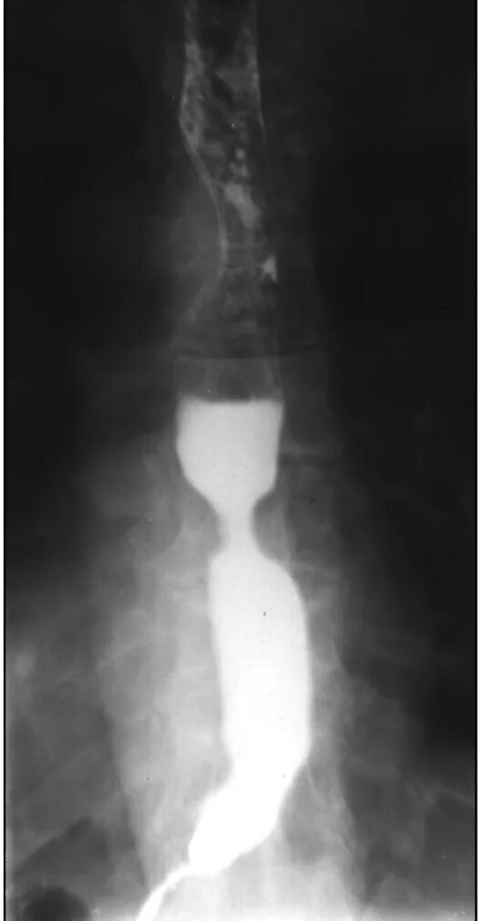 Грыжа пищевода рентген с барием. Рентгенограмма пищевода с барием. Рентген с барием пищевода и желудка. Атония желудка рентген.