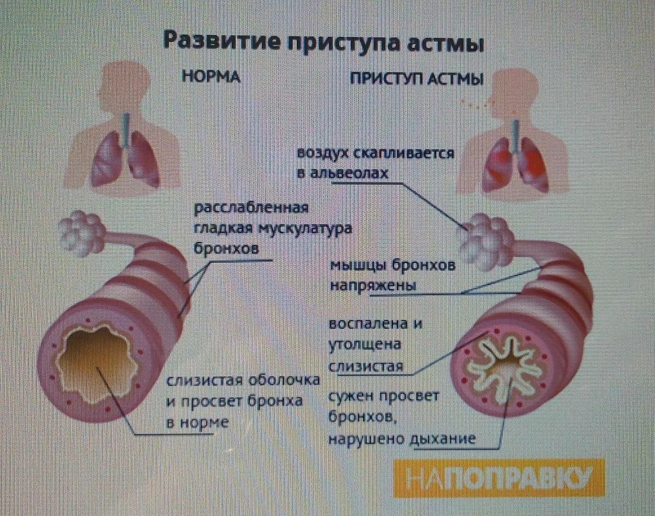 Бронхиальная астма. Бронхи при астме. Аллергическая бронхиальная астма. Бронхиальная астма симптомы.