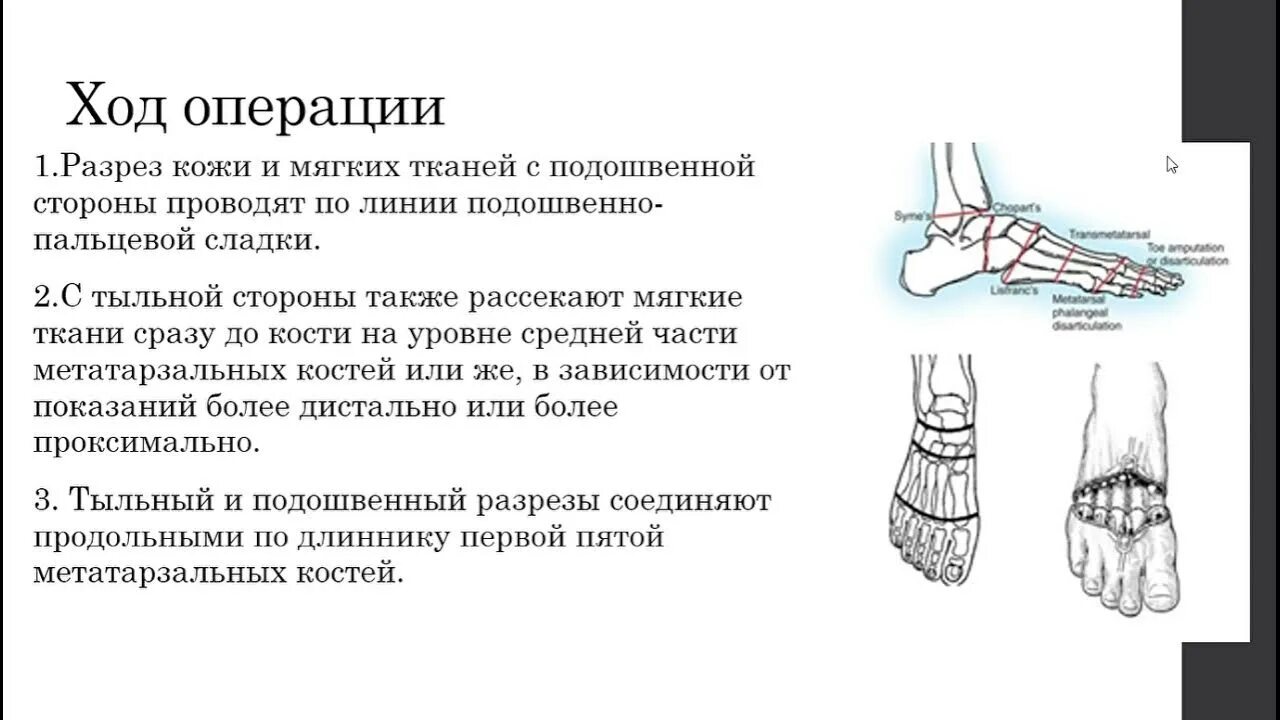 Экзартикуляция стопы по лисфранку. Ампутация стопы по шопару. Ампутация стопы техника операции. Трансметатарзальная ампутация. Ампутация по шарпу и шопару.