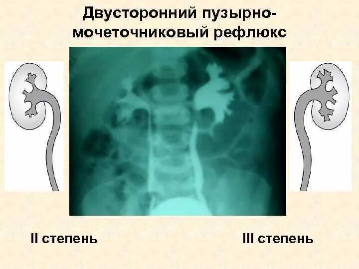 Рефлюкс мочеточника. Пузырно-мочеточниковый рефлюкс рентген стадии. Пузырно-мочеточниковый рефлюкс кт. Классификация пузырно-мочеточникового рефлюкса. Пузырно-мочеточниковый рефлюкс внутривенная урография.