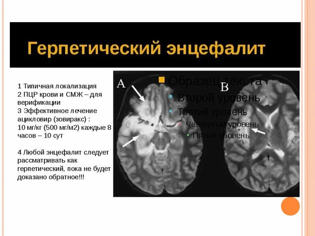 Инфекционные поражения мозга. Гриппозный энцефалит мрт. Герпетический энцефалит кт головного мозга. Герпетический энцефалит поражение головного мозга.