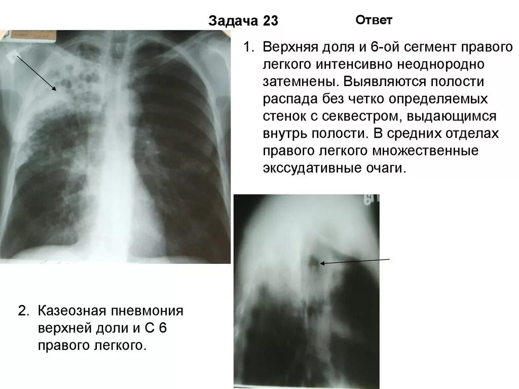 Изменения в верхней доле легкого. Пневмония верхней доли левого легкого. Полисегментарная пневмония s1-s2. Доли правого легкого. Пневмония верхней доли.