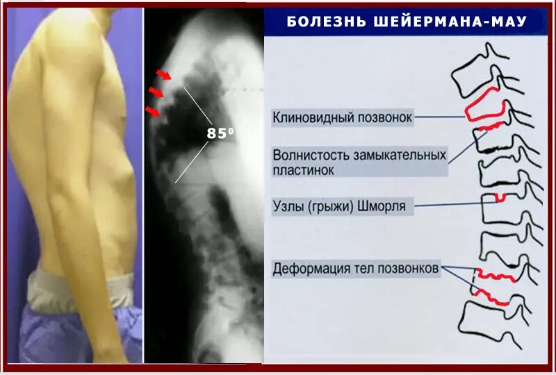 Болезнь шойерман мау что это такое. Остеохондропатия позвонков болезнь шейермана-мау. остеохондропатия шойерман мау. болезнь шейермана мау кт. операция при болезни шейермана мау.