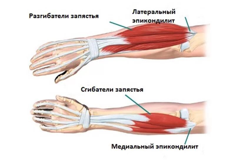 Боли в сухожилиях и мышцах
