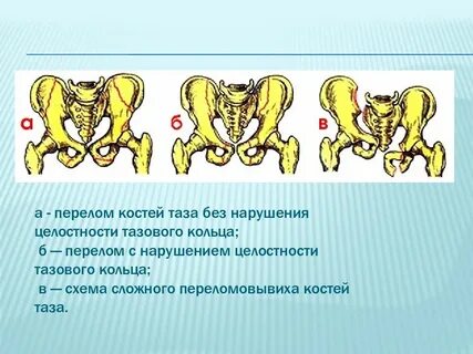 Повреждение таза и тазовых органов