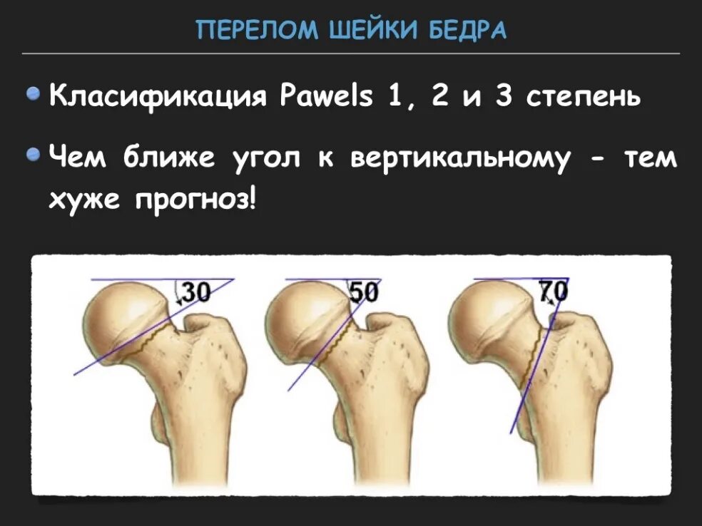 Классификация переломов шейки бедренной кости. Перелом шейки бедра классификация субкапитальный. Субкапитальный перелом шейки бедренной кости. Классификация Pauwels переломы шейки бедра. Трещина шейки