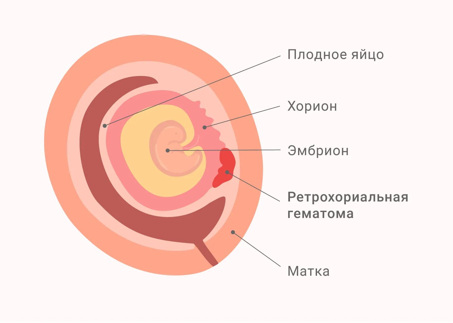 Гематома 6 недель. Ретрохориальная гематома. Retroxorional gematoma. Ретрохориональная гематома. Ретрохориальная гематома при беременности на ранних.