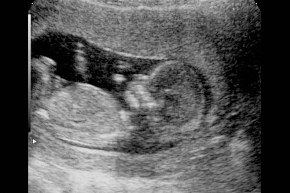 Забеременела в 12 за гранью. Эмбрион на 12 неделе беременности УЗИ. 12 Недель беременности фото плода на УЗИ. УЗИ ребенка на 12 неделе беременности. Снимки УЗИ на 12 неделе.