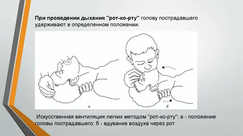 Положение при ивл. Положение при искусственной вентиляции легких. положение головы при проведении искусственного дыхания. положение новорожденного при проведении ивл.