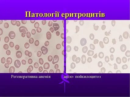 Пойкилоцитоз
