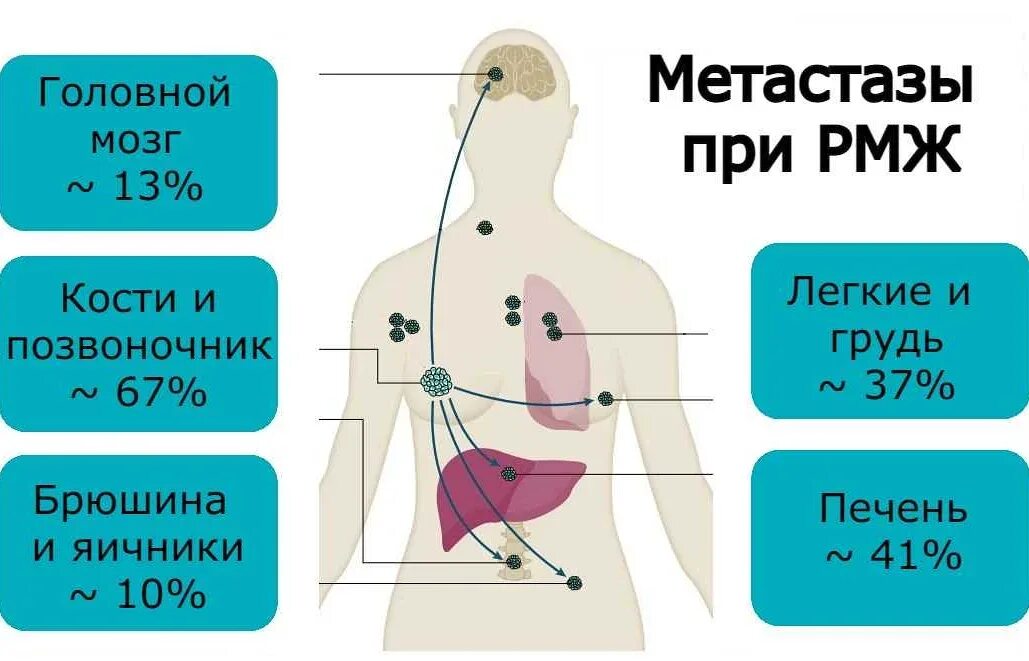 Какая стадия дает метастазы. Метастазы при онкологии груди. метастазы иолочнойжелезы. метастазирование опухолей молочной железы.