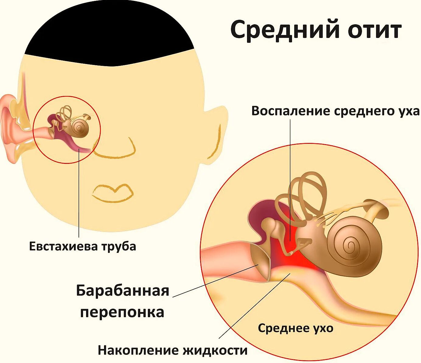 Острый средний серозный отит. Воспаление в средний отит. Острый левосторонний Гнойный отит.