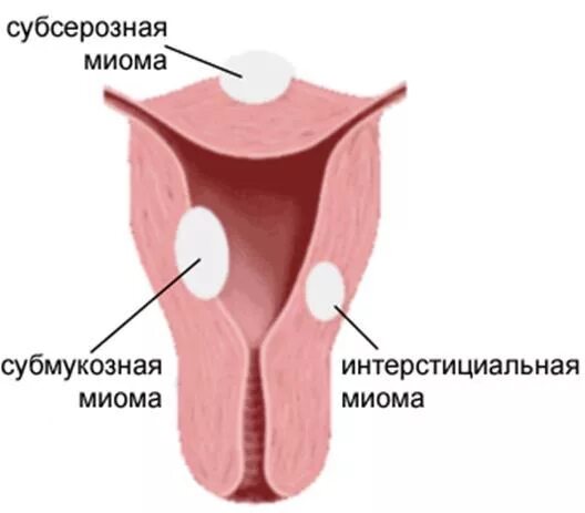 Лейомиома матки что это. Интерстициальная субмукозная миома. Миома субмукозная и субсерозная. Миома интестици субсерозный интерстициальный. Субмукозная миома субсерозная миома.
