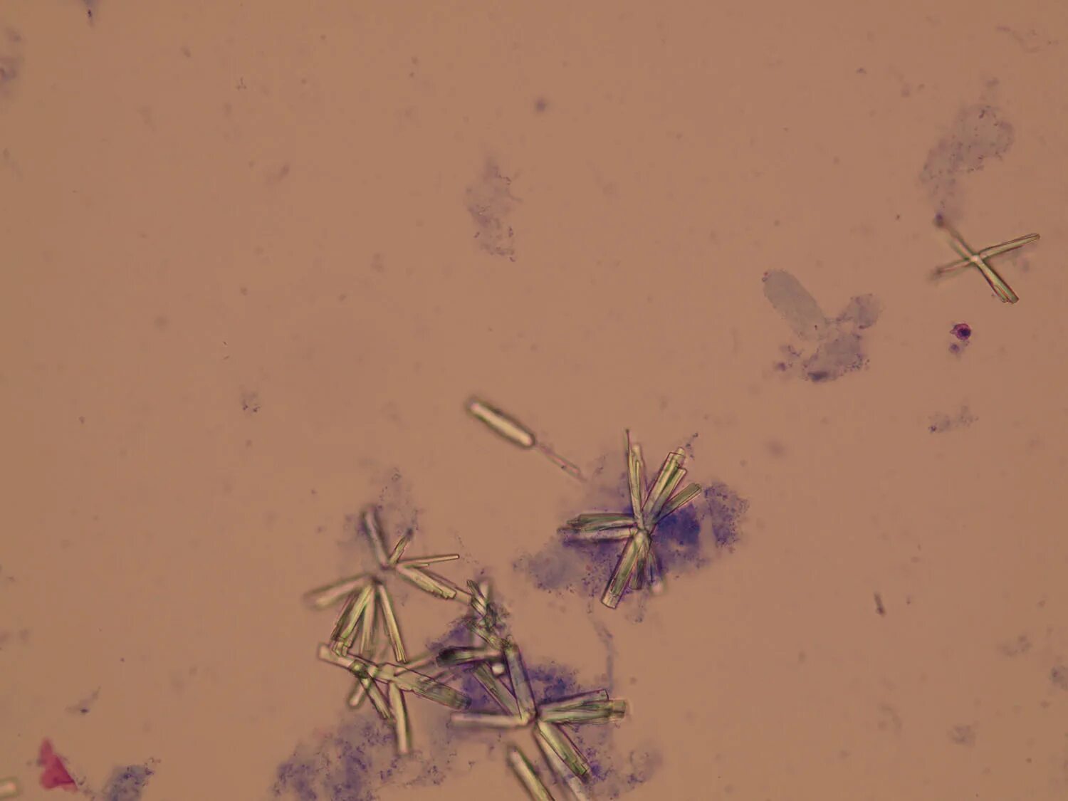 Иглы в моче. Соли мочевой кислоты в моче микроскопия. Кристаллы мочевой кислоты микроскопия. Оксалаты кальция в моче микроскопия. Струвиты микроскопия.