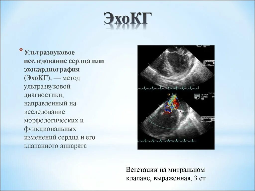 Как проходят эхо. Эхокардиография методы исследования. Эхокардиография принцип метода. Методика ЭХОКГ. Ультразвуковые методы оценки функции клапанного аппарата сердца.