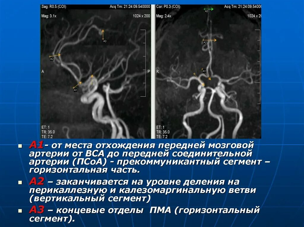 Сегменты средней мозговой артерии на кт. Сегменты внутренней сонной артерии схема кт. Гипоплазия а1 сегмента правой передней мозговой артерии кт. Сегменты средней мозговой артерии схема. Сегмент а1 пма