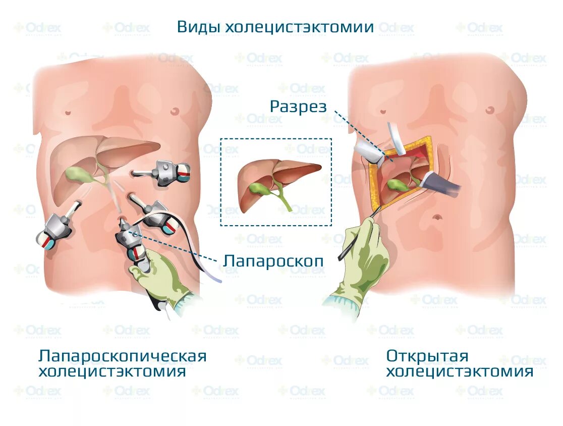 Виды холецистэктомии