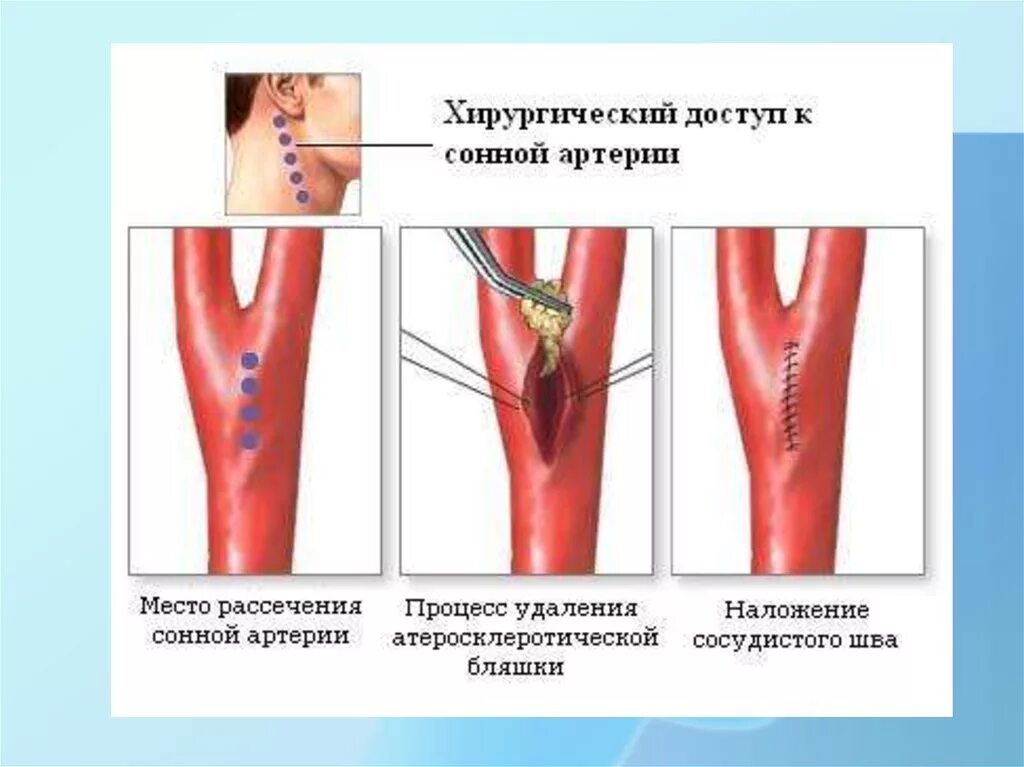 Каротидная эндартерэктомия. Операция каротидная эндартерэктомия. Атеросклероз сосудов сонных артерий. Операция сонной артерии бляшка.