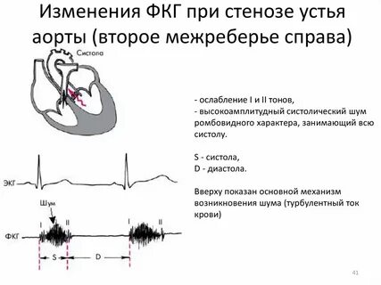 Признаки митрального стеноза