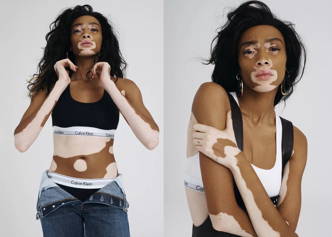 Винни харлоу топ-модель по американски. Два цвета кожи. Два цвета кожи. Шантель браун-янг. Витилиго генетическое.