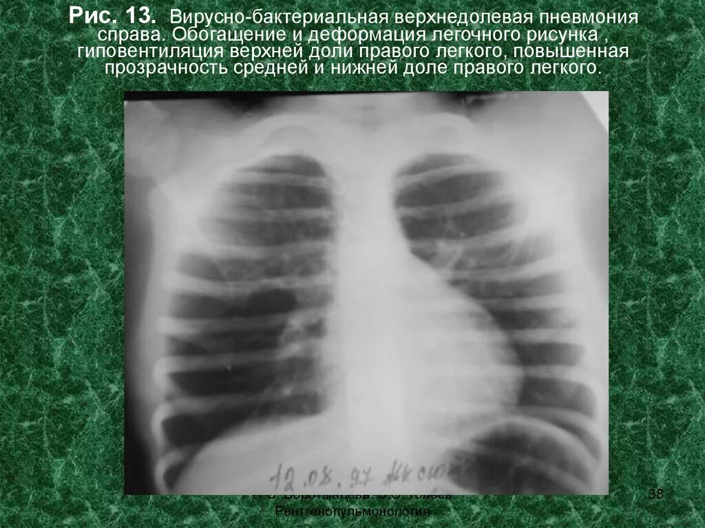 Верхнедолевая пневмония. Правосторонняя верхнедолевая пневмония на рентгене. Гиповентиляция верхней доли рентгенограмма. Легочный рисунок деформирован. Рентгенограмма при верхнедолевой пневмонии.