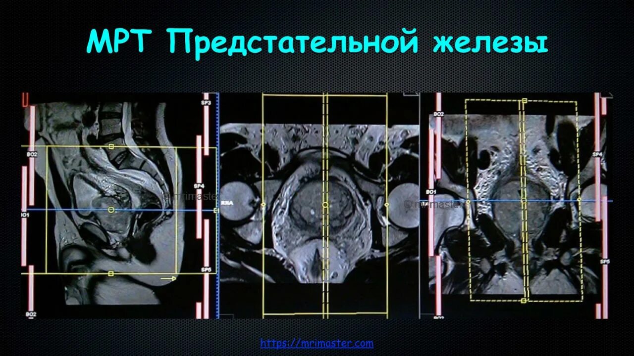 Аденома простаты мрт. Мультипараметрическое мрт предстательной железы. Магнитно-резонансная томографии (мрт) предстательной железы. Предстательная железа мрт сагитал.