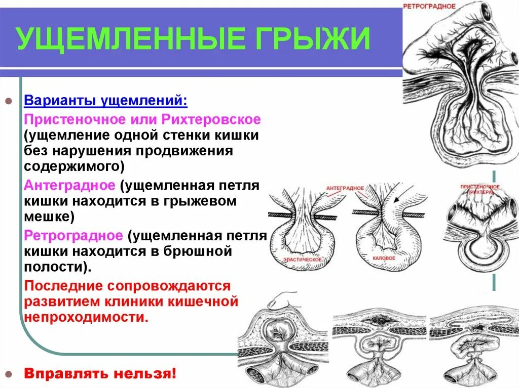 Механизм калового ущемления грыжи. Пристеночное Рихтеровское ущемление.