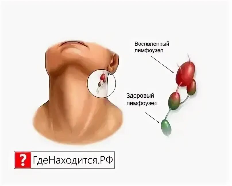 Околоушные лимфатические узлы схема. Где находятся лимфоузлы на шее у мужчин. Где находятся лимфоузлы на шее у мужчин. Отток лимфы на лице схема. Ушные лимфатические узлы анатомия.