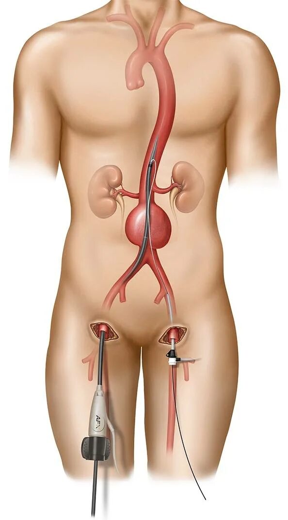 Стент брюшной аорты аневризма. Эндоваскулярное стентирование аорты. Аневризмах брюшной аорты. Псевдоаневризма брюшной аорты. Операция через сосуды