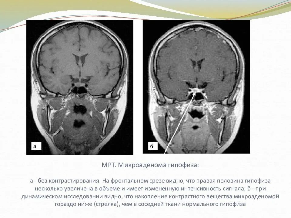 Мрт микроаденома гипофиза мрт. Кт признаки аденомы гипофиза. Кистозная форма аденомы гипофиза мрт. Аденома гипофиза при кт.