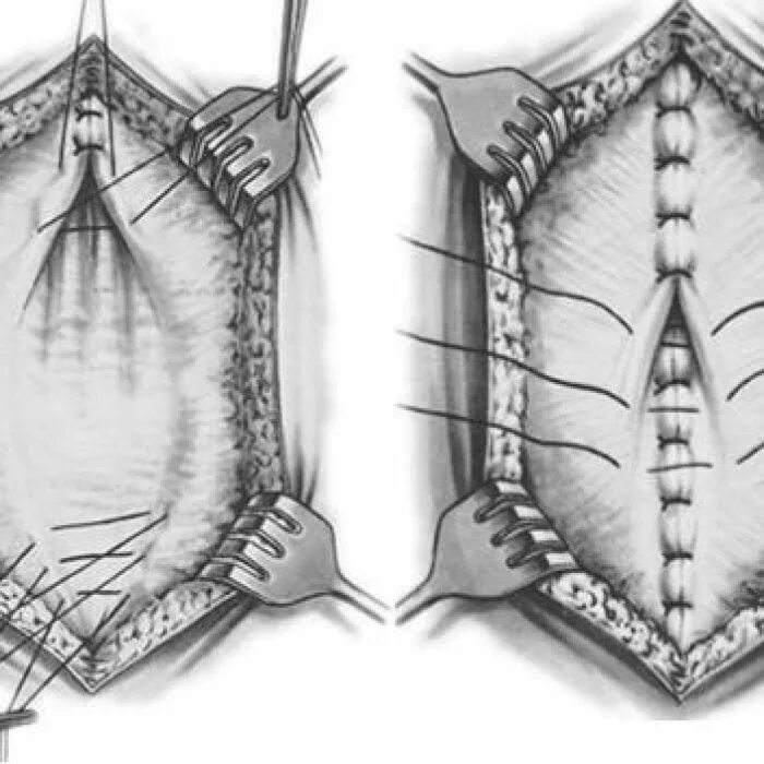 Ушивание разрывов. Диастаз мышц живота 1 степени. Диастаз мышц живота 2 степени. Диастаз живота операция. Диастаз по белой линии.