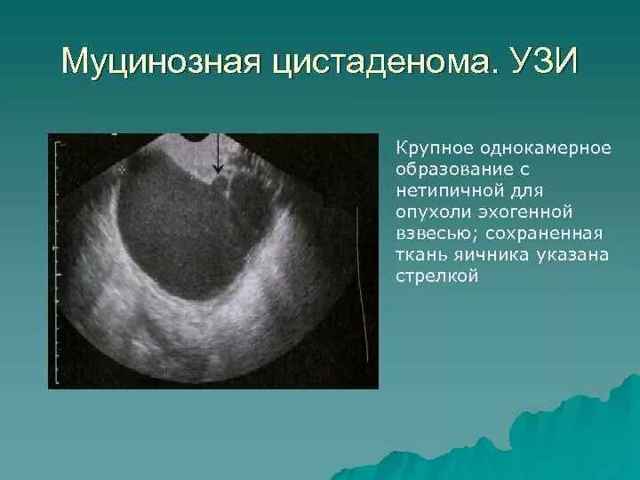 Лечение кисты в менопаузе. Серозная папиллярная цистаденома УЗИ. Доброкачественная опухоль яичника УЗИ. Цистаденома яичника на УЗИ. Серозная цистаденома яичников.