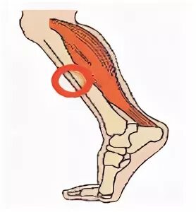 Боль в голени с наружной стороны.