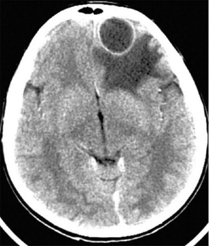 Абсцесс головного мозга кт. Внутримозговой абсцесс кт. Риногенныйабсцессголоного мозга. Гнойный мозг