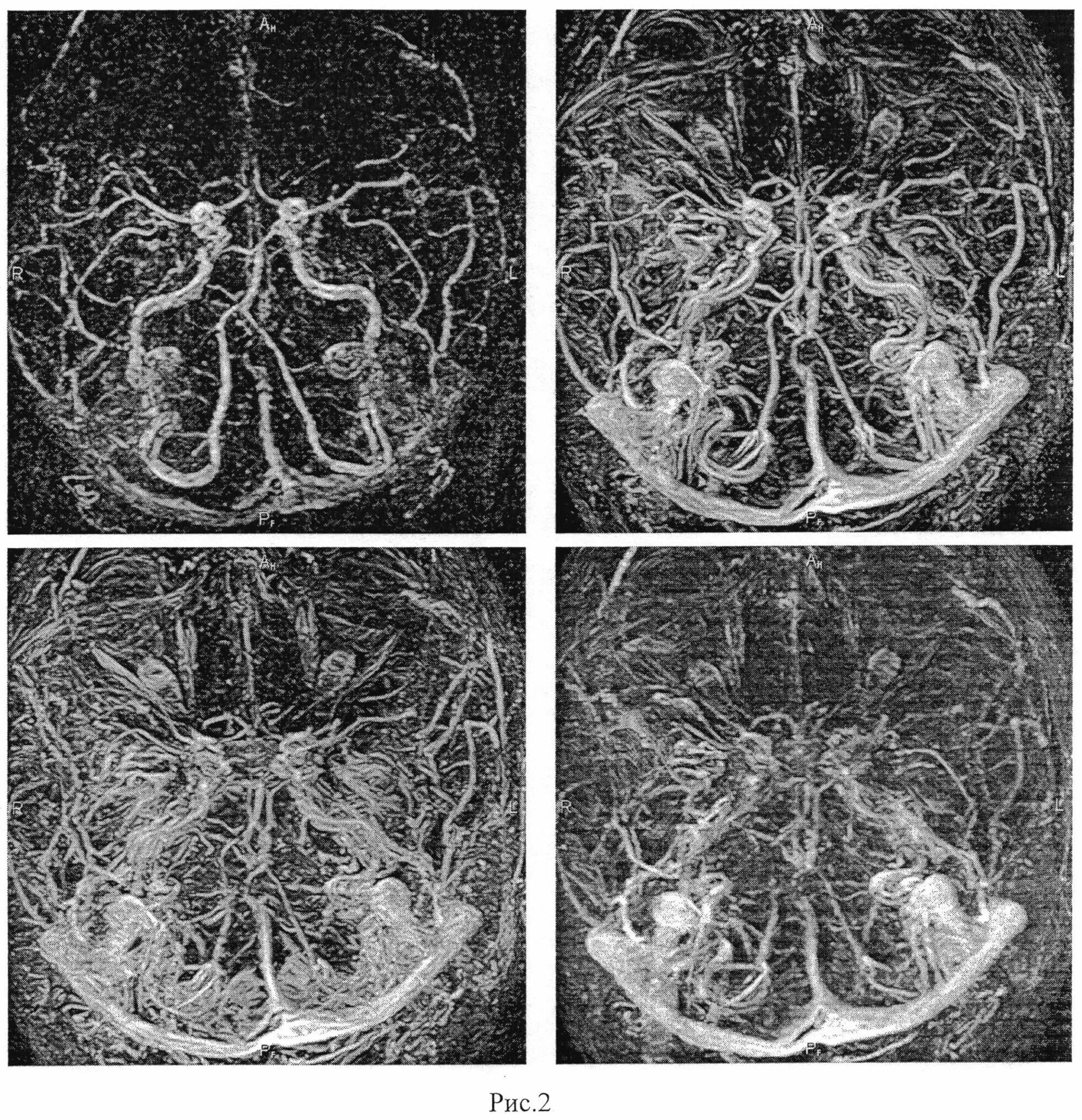 Бесконтрастная ангиография. Магнитно резонансная венография. МСКТ ангиография артерий головного мозга. Мрт головного мозга с ангиографией.